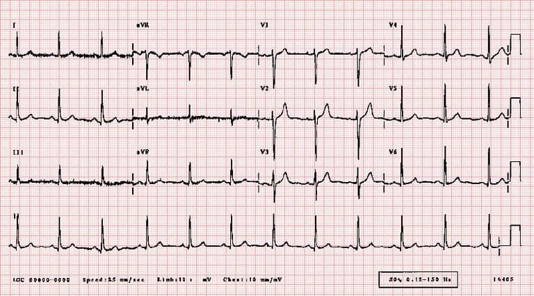 Understanding Abnormal Heart Rhythms (Arrhythmias)