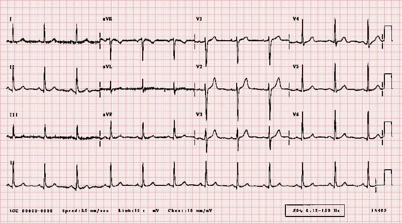 Understanding Abnormal Heart Rhythms (Arrhythmias)