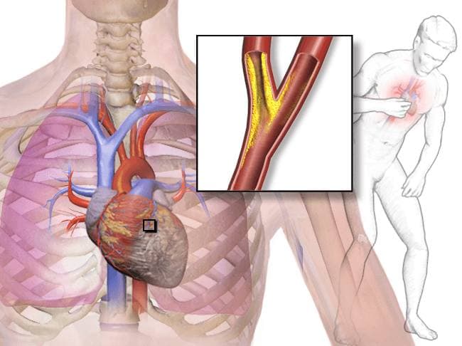 Understanding Angina: Chest Pain, Warning Signs, and What You Should Know
