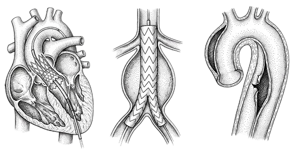 Complex Aortic Surgery